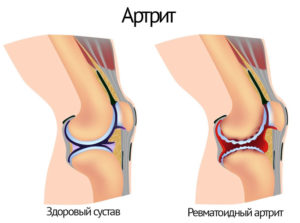 Болит левый бок колена