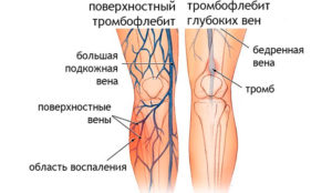 Жжет ногу выше колена лечение