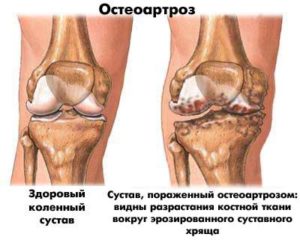 Почему болят колени у женщин после 40