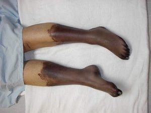 Потемнение голени ноги лечение