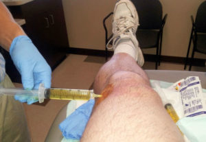 Болит колено при разгибании после сидения thumbnail