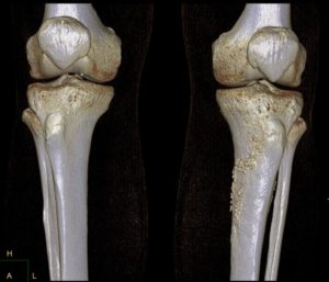 Боль в коленном суставе при сгибании и ходьбе лечение народными средствами