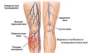 Боль в ноге от паха до колена с внутренней стороны лечение