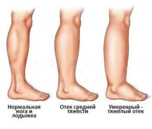 Горят ноги ниже колена лечение
