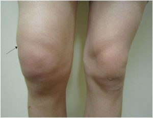 Признаки скопления жидкости в коленном суставе