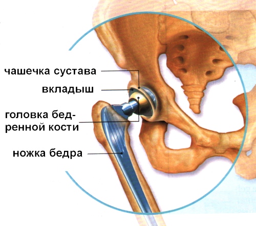 Схема реабилитации после эндопротезирования тазобедренного сустава