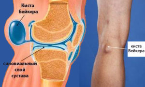 Опухоль в коленном суставе причины и лечение