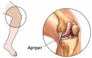 Изображение - Почему болят коленные суставы когда спишь ночью artrit11-300x188