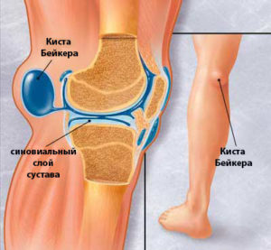Изображение - Боль в коленном суставе при разгибании причины bakers-cyst-300x277