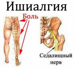 Болит внутренняя сторона ноги выше колена