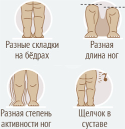 Изображение - Почему у ребенка щелкают суставы на ногах lecheniedisplaziitazobedrennyhsustavov5