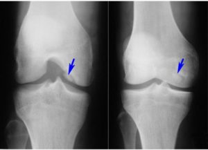 Рентгенография колена снимок здорового коленного сустава описание и расшифровка