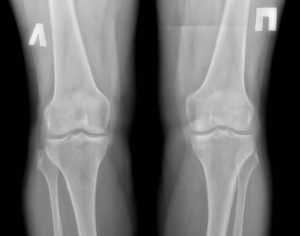 Рентген коленного сустава стоя: сделать рентген снимок коленного сустава в Одинцово и Звенигороде, артроз коленных суставов рентген