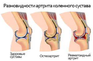 Изображение - Боль в суставе при спуске по лестнице revmatoidnyj-artrit-300x197