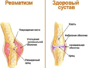 Заболевание коленного сустава опухоль