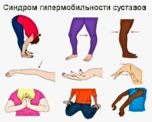 Изображение - Почему болят коленные суставы когда спишь ночью sindrom-gipermobilnosti-sustavov-4-300x240