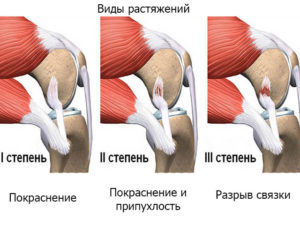 Болит колен при неловком движении