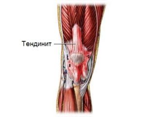 Болит коленный сустав при разгибании народная медицина thumbnail