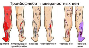 Печет ногу ниже колена лечение