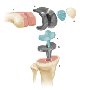 Виды и способы проведения артропластики коленного сустава