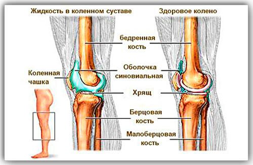 Скопление жидкости около латерального мениска. Застарелое повреждение мениска коленного сустава лечение. АНАТОМИЯ. Латеральный мениск: причины повреждения, лечение Боль в колене - Центр доктора Бубновского