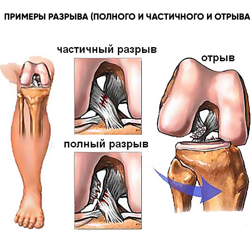 Парциальный разрыв. Симптомы растяжения передней крестовой связки. Передняя крестообразная связка коленного сустава. Повреждение крестообразной связки коленного сустава. Передняя крестовая связка колена.