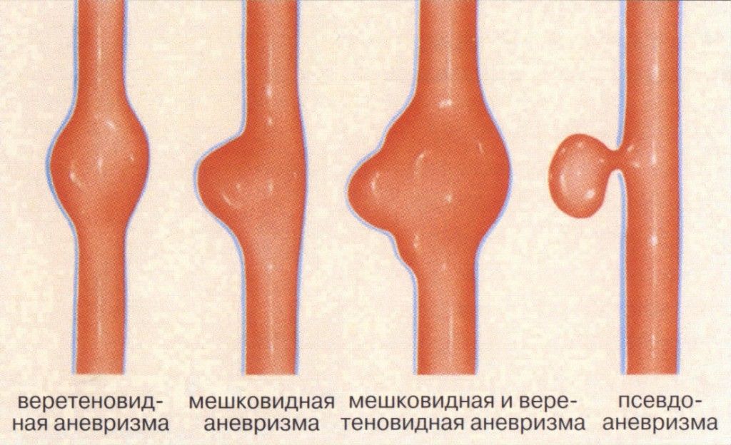 Виды маленьких сосудов. Микотическая аневризма. Цилиндрическая аневризма аорты. Мешковидная аневризма брюшной аорты. Псевдоаневризма и аневризма.