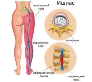 Болит коленный сустав при ходьбе и сгибании лечение