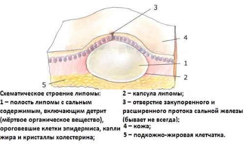 Хирургическое удаление липомы (жировика)