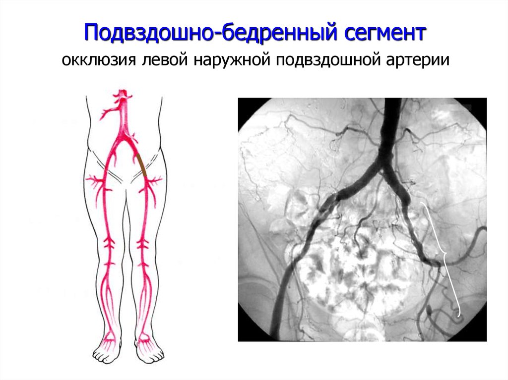 Артерия ноги операция. Бифуркационное аорто-бедренное шунтирование. Атеросклероз подвздошных артерий рентген. Операция подвздошно бедренное шунтирование. Ангиография артерий нижних конечностей.