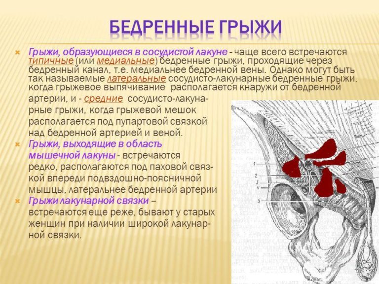 Паховая грыжа у мужчин симптомы справа внизу живота фото