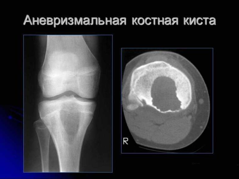 Киста правой подвздошной кости фото