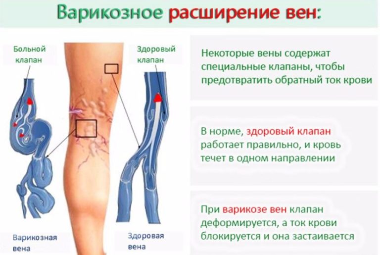 Где находится бедренная вена у человека фото