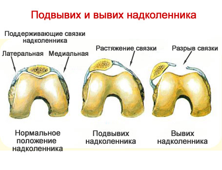 Вывих коленного сустава карта вызова скорой медицинской