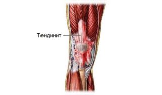 Тендинит сухожилия четырехглавой мышцы бедра лечение народными средствами thumbnail