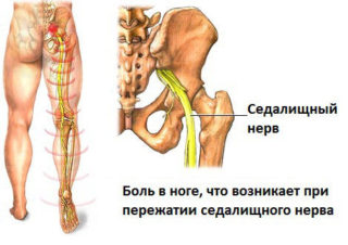 Боль в бедре при ходьбе в верхней и передней части сбоку в суставе с внутренней стороны