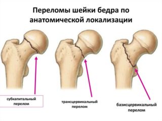 Повреждение тазобедренного сустава бедренной кости thumbnail