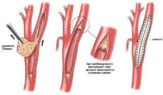Атеросклероз окклюзия бедренных артерий стеноз