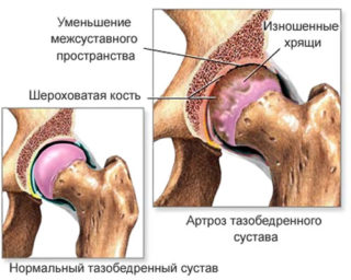 Ушибы мышц с гематомами на бедре