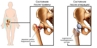 Изображение - Формирование ложного сустава при переломе шейки бедра Hip_fracture2-320x159