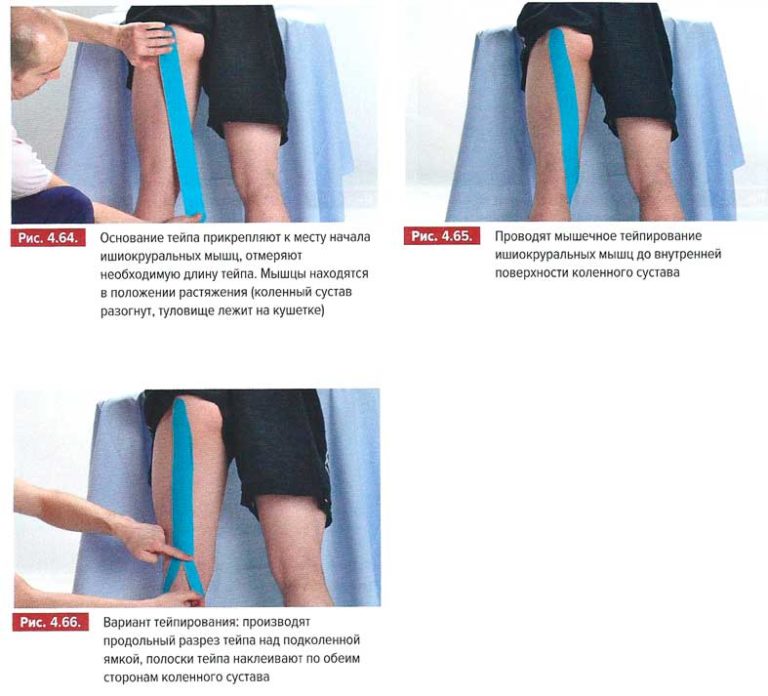 Тейпирование ног для похудения и подтяжки схема