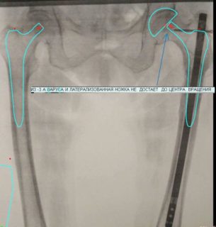 Варусная деформация тазобедренных суставов лечение