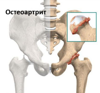 Ушиб лобковой кости последствия