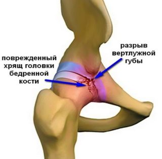 Болит нога в области тазобедренного сустава при беге