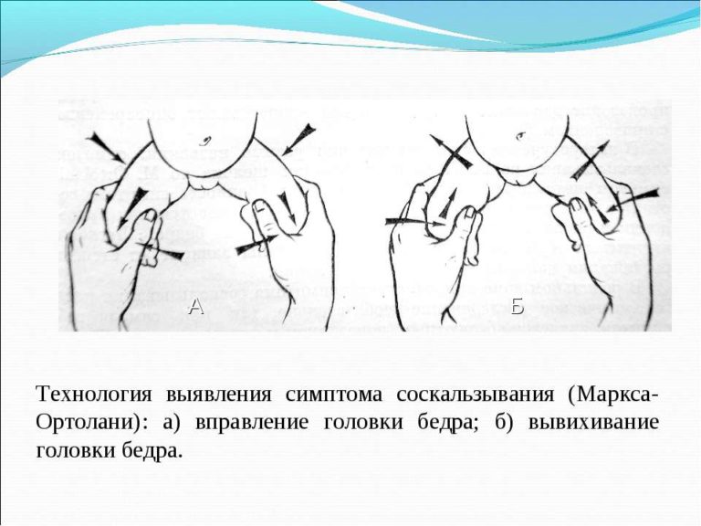 Врожденный вывих бедра презентация травматология