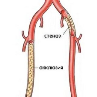 Атеросклероз окклюзия бедренных артерий стеноз