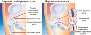 Изображение - Беременность болит нога в тазобедренном суставе razrushenie-hryaschevoy-tkani-pri-artrite-768x294-320x123