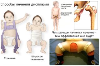 Изображение - Лечение тазобедренного сустава у подростков rebenok-4-goda-bol-v-tazobedrennom-sustave-320x213