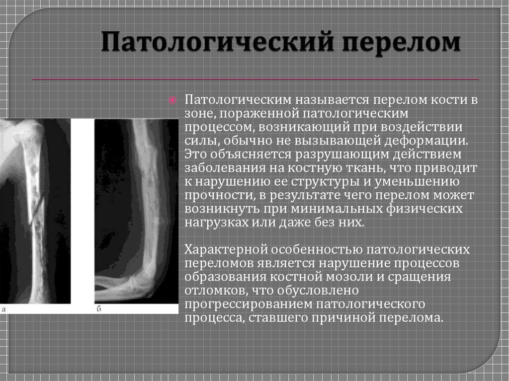 Метастатическое поражение костей. Рентгенограмма патологический перелом бедра. Метастазы в бедренной кости рентген. Патологический перелом бедренной кости метастазы. Патологический перелом остеомиелит бедра.