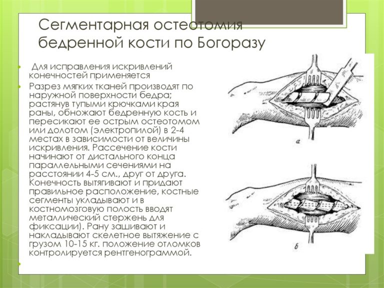 Винирная пластика и межкортикальная остеотомия презентация